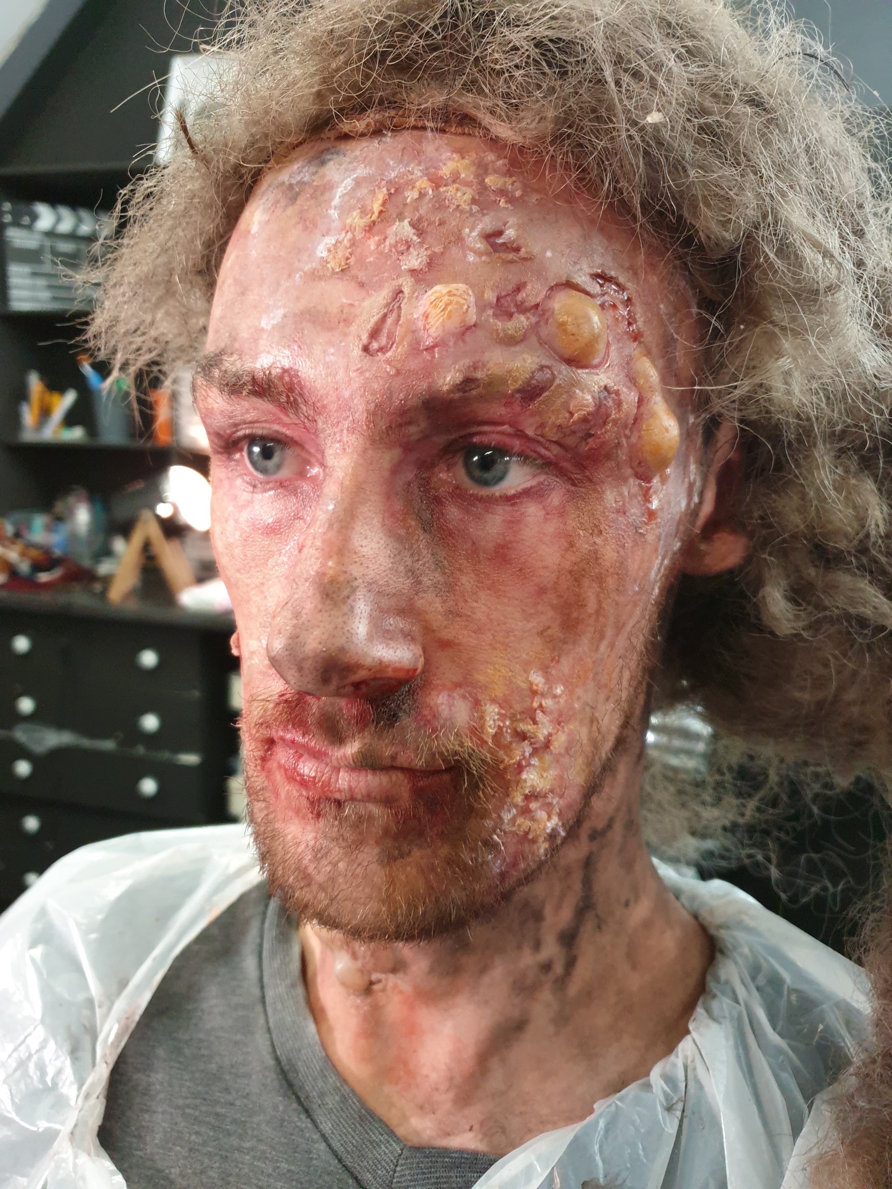 Prosthetic Work